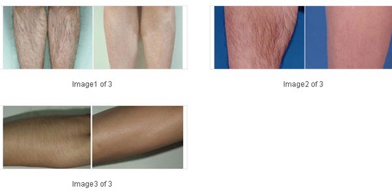 Water Cooling Ipl Permanent Hair Removal , Tattoo Removal Ipl Beauty Machine OEM / ODM