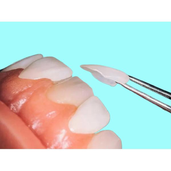 Фирма облицовки фарфора изготовленного на заказ OEM зубоврачебная износоустойчивая для зубоврачебного восстановления