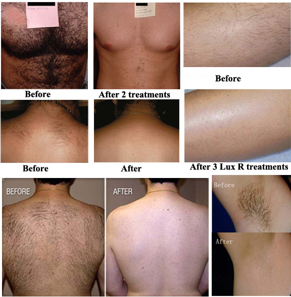 Clinic  E - Light Ipl Rf Body Hair Removal Machine Skin Treatment Equipment