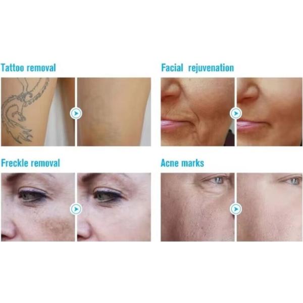 Eliminación de vello con láser de diodo Rejuvenecimiento de la piel Máquina de belleza Pico láser 2 en 1