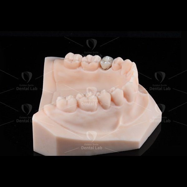 74% Yellow Gold Crown PFM High Noble Porcelain Fused To Metal Crown