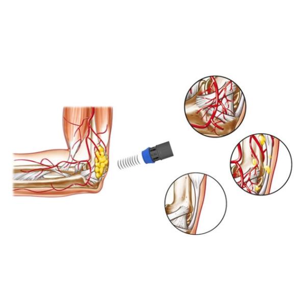 Вертикальная машина Китай терапией ударной волны 16Hz для эректильной дисфункции