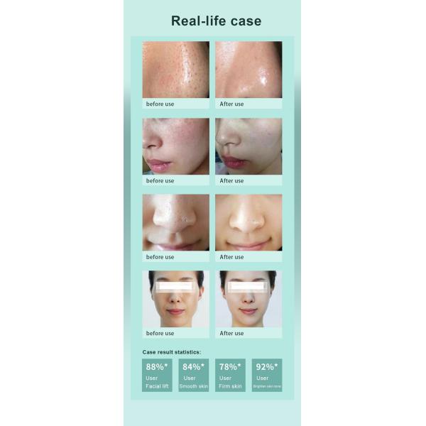 Dermabrasion 65Khz Oxygen Hydrafacial Machine Bubble Deep Cleaning