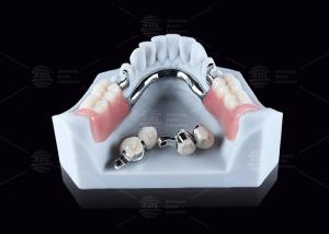 CEKA M2 Precision Attachment Titanium With 3mm Horizontal / Vertical Clearances