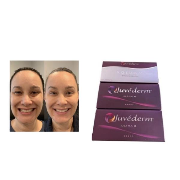 Гиалуроновая кислота гель для инъекций наполнитель для лица Juvederm Ultra 3 Ultra 4 Voluma