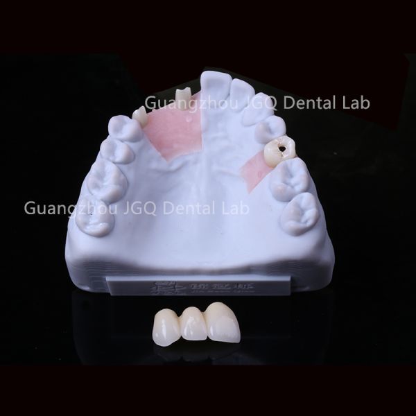 Dental Zirconia Custom Abutment Lab Precise Esthetical As Strong As Titanium