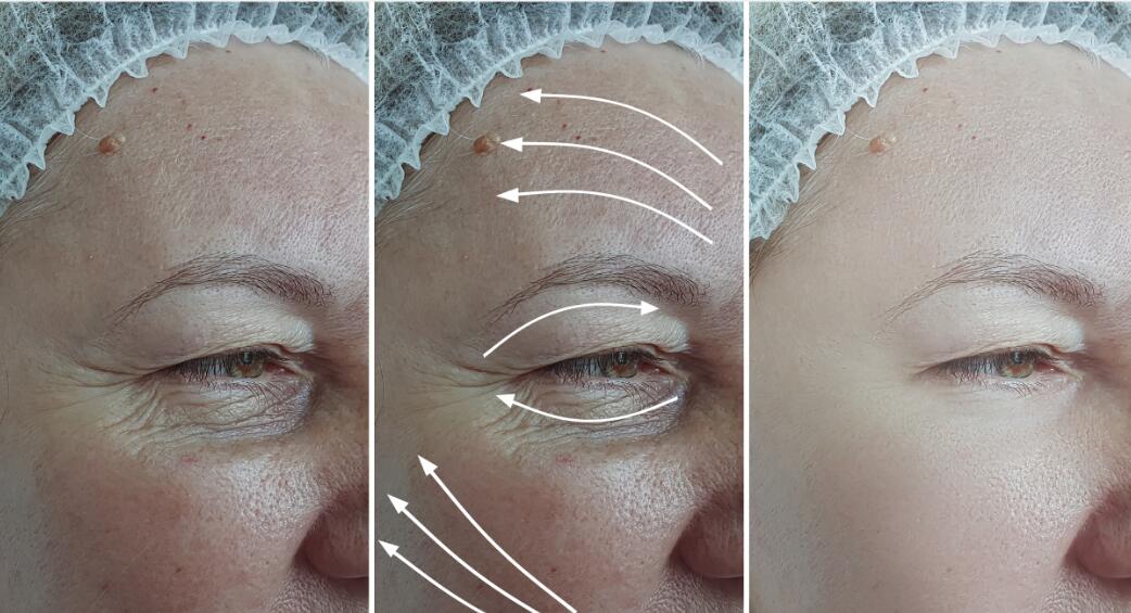 Заполнитель Skinject Hyaluronic кисловочный дермальный для увеличения батокса губ