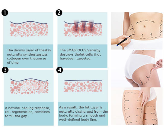 22D Body Weight Loss Vaginal Tightening Face Lift Anti Aging Focused Ultrasound HIFU Machine
