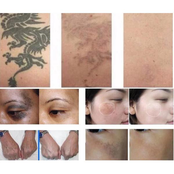Picosure Q Switched Nd Yag Laser Tattoo Removal / Pigmentation Removal Machine