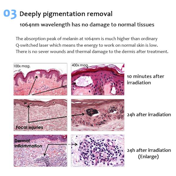 Nd Yag Laser Tattoo Removal Machine
