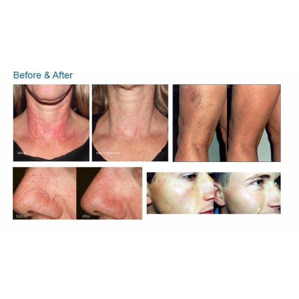 980nm medical diode laser spider vein removal machine/980nm laser vascular vein removal machine/evlt laser