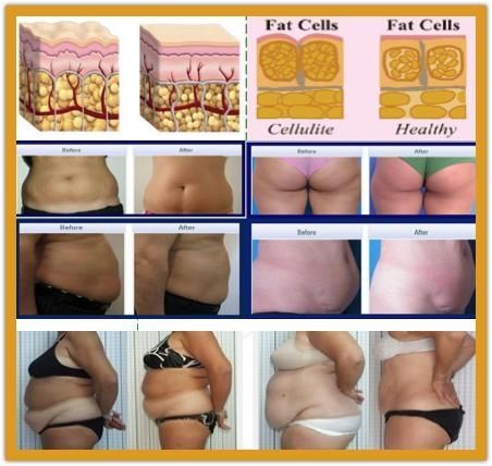 Non-invasive Cryolipolysis Body Slimming  Machine with Color Touch Screen