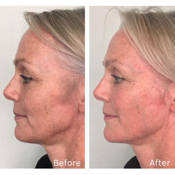 1.1ml Revolax SubQ Cross Linked HA Filler