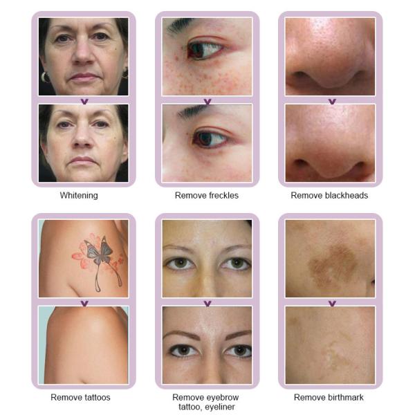 1064nm 532nm Nd Yag Laser Tattoo Removal Machine 800W Freckle Birth Mark Removal