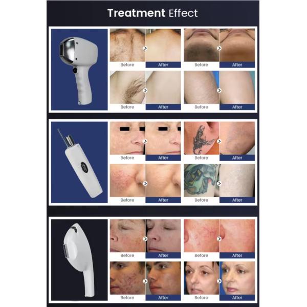 D31-3 Professional Ipl Hair Removal 808nm Diode Laser Carbon Peel Nd Yag Picosecond Laser With Measuring Rod