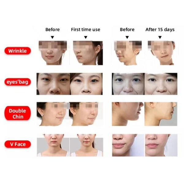 Anti Aging Body Massage Rf Thermolift Machine 2 In 1 Face Lift