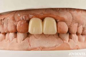 Multilayer PMMA Polymethyl Methacrylate For Dental Restorations