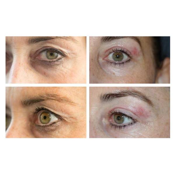 58 - 68khz Multifunctional Beauty Machine , Eyelid Wrinkle Removal Micro Plasma Pen