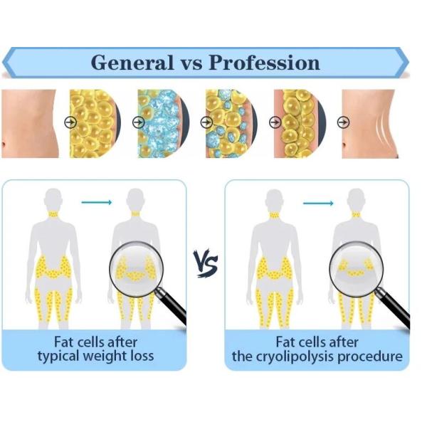 5 In 1 Cryolipolysis Slimming Machine , Cavitation RF Weight Reduction Equipment