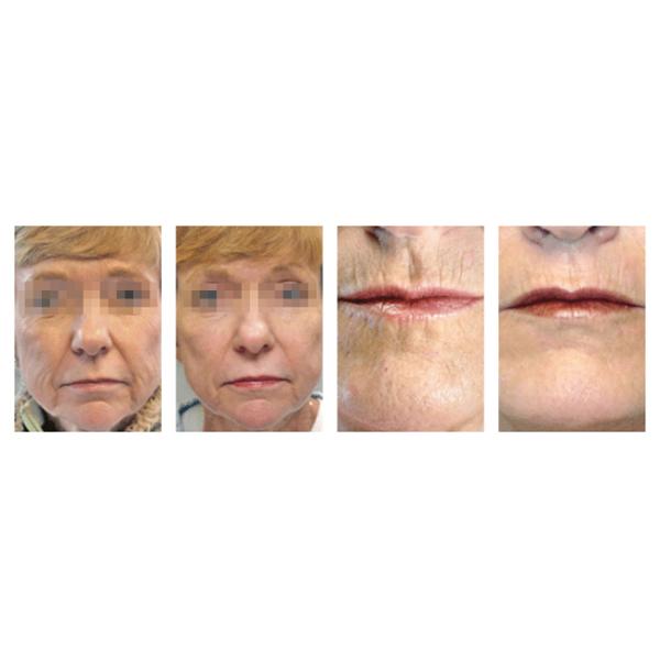 Salon Multifunction Fractional Co2 Laser Equipment For Acne Scars Medical