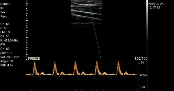 Wireless Linear Probe High Frequency Probe Special Tool for Visual Puncture Guidance Integrated Handheld Ultrasound Scanner