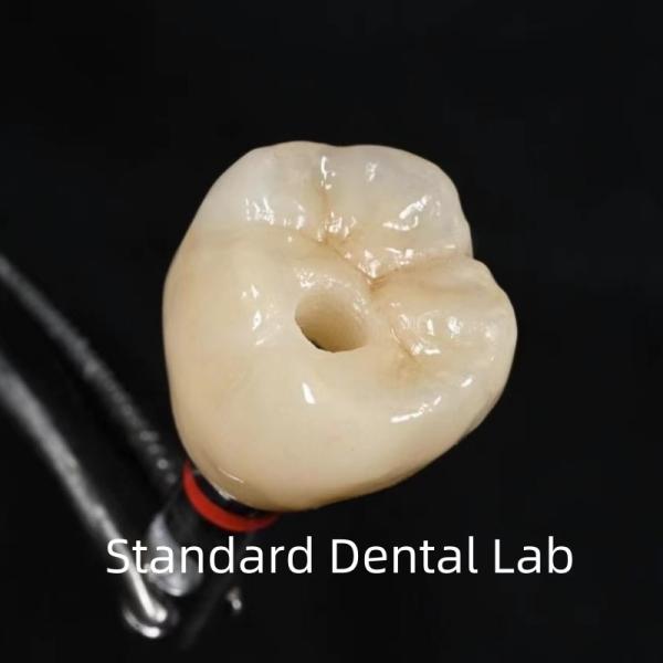 Couronne d'implant dentaire à vis