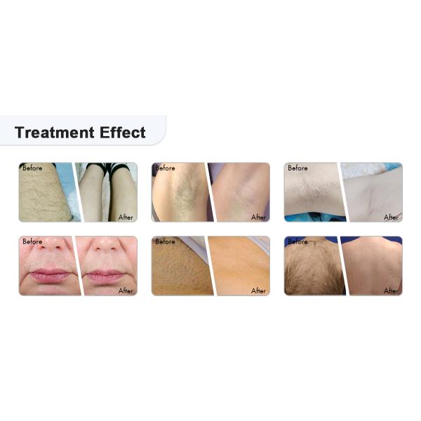 Beauty Salon Use High Powerful Depilator 4 Wavelength 2000W Diode Laser 808Nm Laser Hair Removal Machine