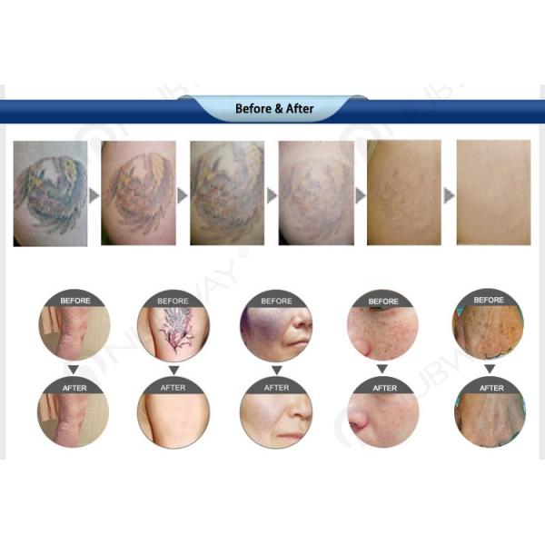 Factory Price Q Switch Nd Yag Laser Tattoo Removal System , Long Pulse Nd Yag Laser Tatto Removal Machine
