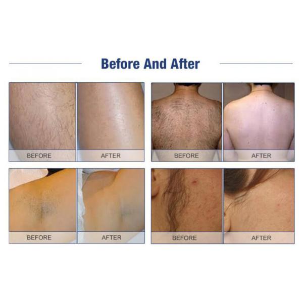 High Power Epilator IPL 360 Magneto Optic Machine For Hair / Acne Acne Removal