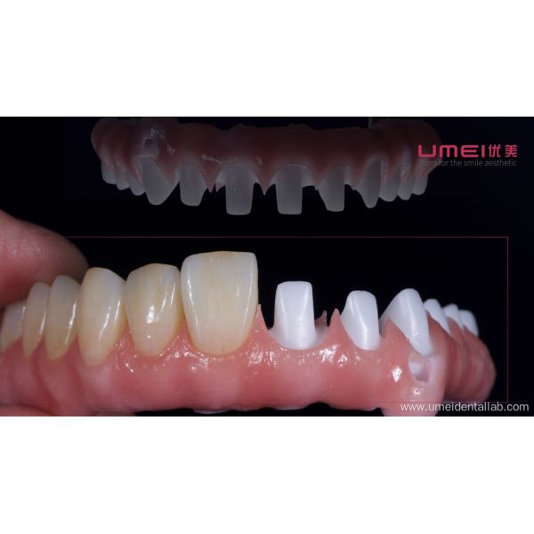 Full Arch Zirconia Malo Bridge