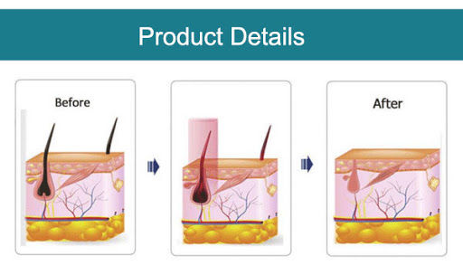 Single 6mm Laser Rod Q Switch Nd Yag Laser Tattoo Removal Ipl Handle