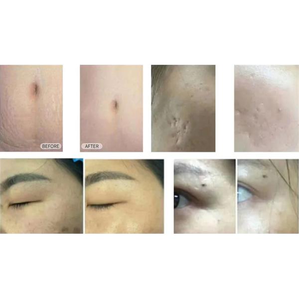 Портативная частичная красота удаления угорь шрама машины лазера СО2 10600nm