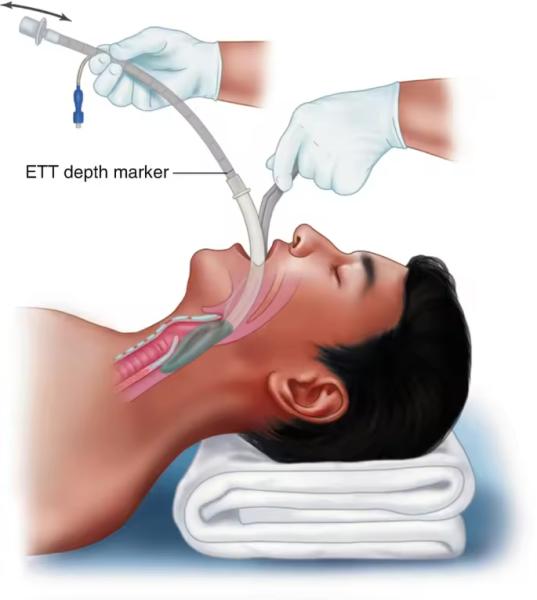 Masque laryngéal en PVC médical en silicone avec voie aérienne approuvée CE et ISO