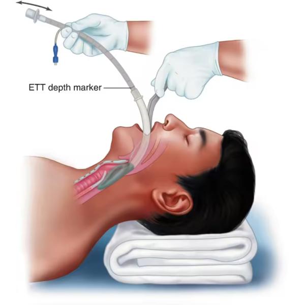 Medical Silicone Lma Material Reusable Flexible PVC Laryngeal Mask Airway Wholesale Supplier
