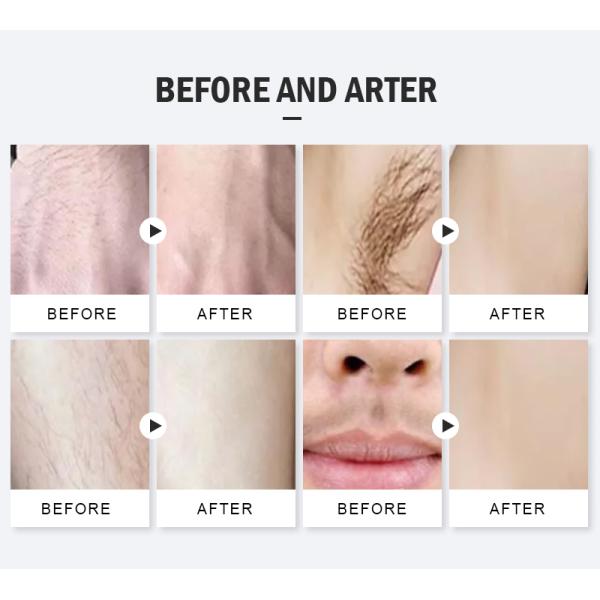 High Quality 755 810 1064 Intelligent Painless Titanium Upgrade Ice Laser Hair Device Diode Laser Hair Removal Epilation
