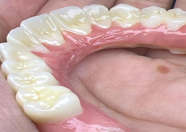 Implante de base de titânio polido ponte de coroa cerâmica para restauração dental