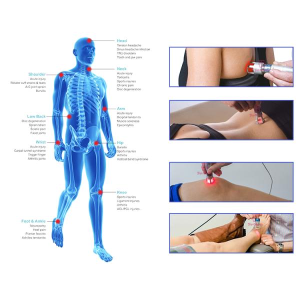 soulagement de la douleur de machine de laser de la physiothérapie 980nm et guérison améliorée