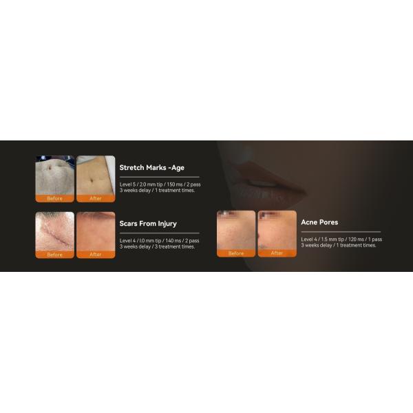 Fractional Micro Needle Vacuum RF Machine RF Vacuum Lifting Microneedling Machine