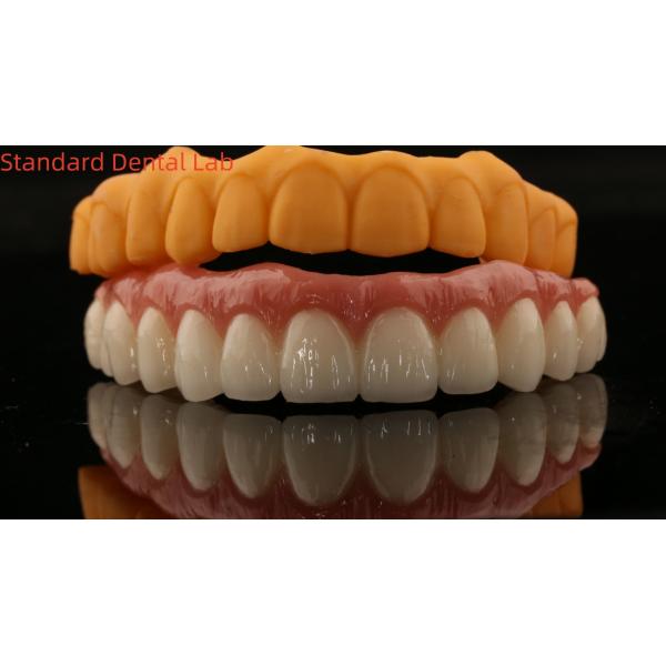 Porcelain All On Four Zirconia Bridge High Esthetics Dental Implant Bridge Screw Retained