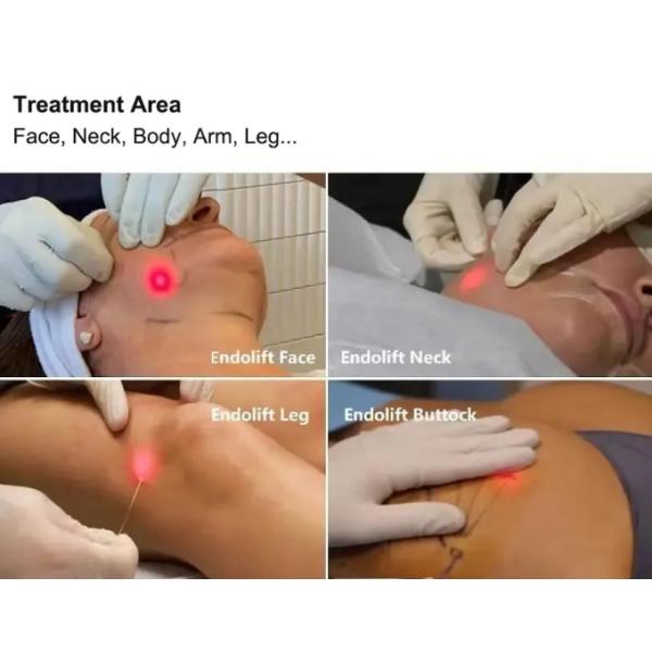 1470nm 980nm Diode Laser Hemorrhoids Treatment Liposuction Body Slimming Machine