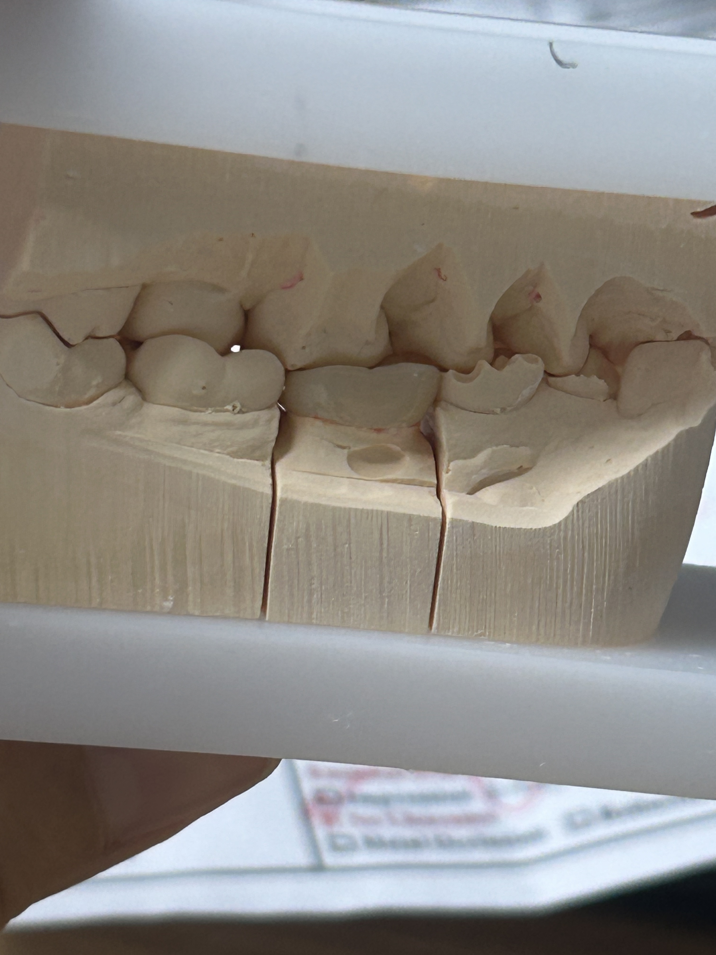 High-Strength Dental Zirconia Crown with Patient-Specific Digital Design and CAD/CAM Production for Posterior Teeth