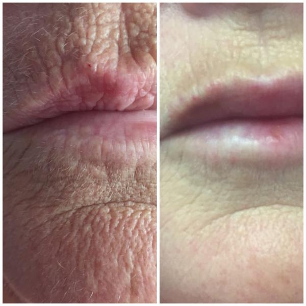 2017Hot sale Fractional RF and Microneedle RF beauty Machine/fractional micro-needle rf skin