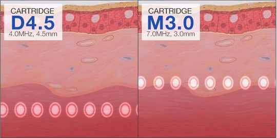 Женская частная машина заботы 3Д ХИФУ, влагалищная затягивая кожа затягивая машину