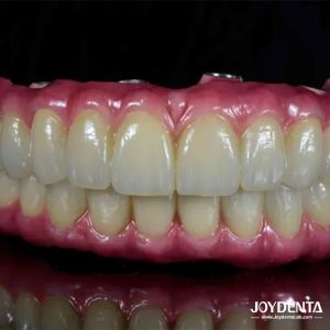 Lightweight Dental Titanium Malong Hybrid Bridge Comfortable For Dental Restoration