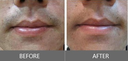 Painless Super Hair Removal 810nm Diode Laser Depilation Machine