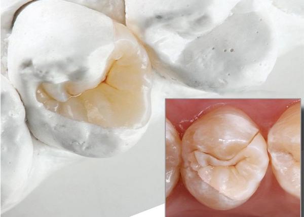 Laboratório Dentário de Aparência Natural Incrustação Cerâmica e Onlay para restauração dental precisa