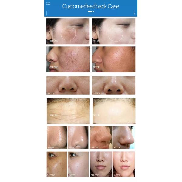 Hydra microdermoabrasión hidrodermoabrasión aqua facial jet peel máquina equipo de belleza