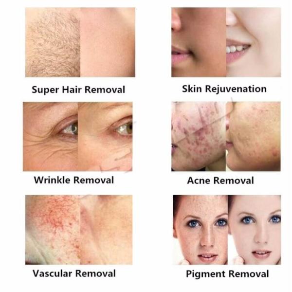 3 In 1 Epilator Yag Laser Tattoo Removal Machine 532nm / 1032nm / 1064nm Wavelength