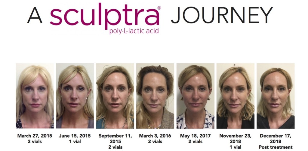 PLLA Poly- L- Lactic Acid 1 флакон X 5 мл Dermal Fillers Demal Filler Антивозрастная пластическая хирургия лица