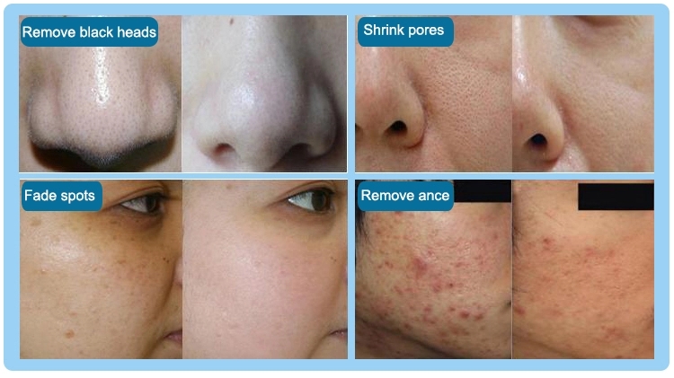 Диамант Dermabrasion 4 подсказок слезает гидро лицевые машины